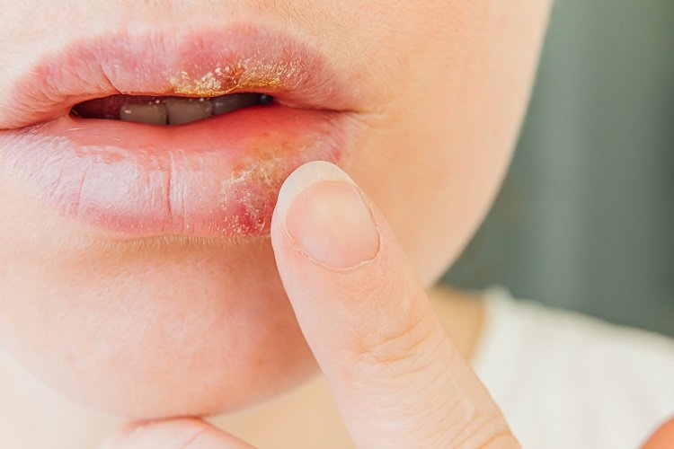 Heal Herpes Sores Quickly: Proven Tips to Stay Symptom-Free